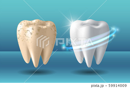 Clean and dirty tooth before and after whitening 59914009