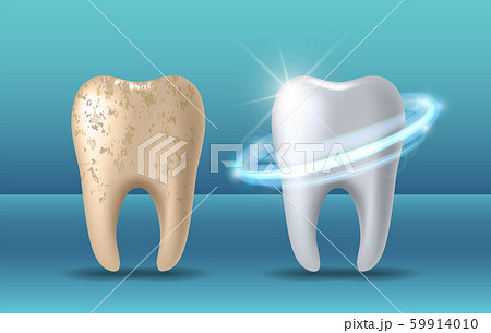 Clean and dirty tooth before and after whitening 59914010
