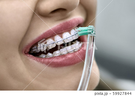 Closeup view at female teeth with bracket system Closeup view at female teeth with bracket system 59927844