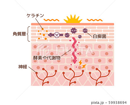 水虫のかゆみ発生のメカニズム 皮膚断面図 図解イラストのイラスト素材