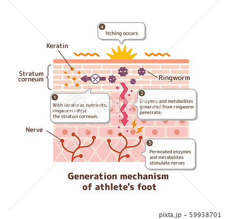 水虫のかゆみ発生のメカニズム / 皮膚断面図 図解イラスト（解説付き・英語） 59938701
