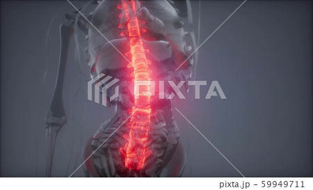 Backache in Back Bones Backache in Back Bones 59949711