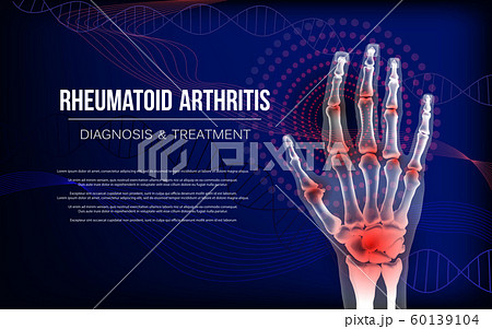 Rheumatoid arthritis osteoarthritis banner inflammation joints of bones of hand. 60139104