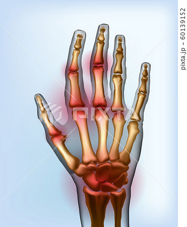 Frontal view image sore osteoarthritis joints of bones the of hand. 60139152