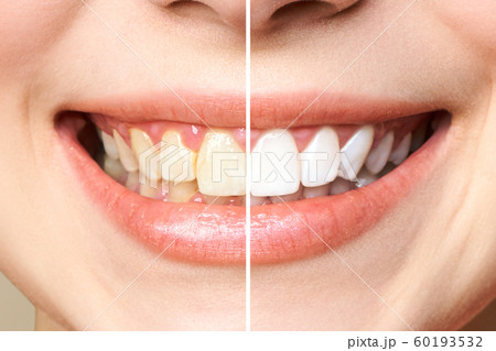 woman teeth before and after whitening. Over white background. Dental clinic patient. Image symbolizes oral care dentistry, stomatology woman teeth before and after whitening. Over white background. Dental clinic patient. Image symbolizes oral care dentistry, stomatology 60193532