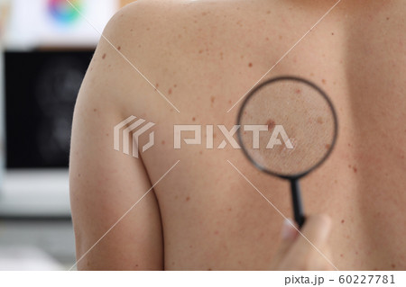 Macro shot of doctor checking mole 60227781