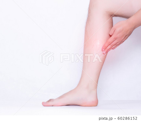 A man rubs a medical ointment in the damaged leg and calf muscle, a healing cream for stretching the ligaments and against inflammation, pain relief, copy space 60286152