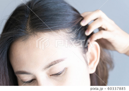 Woman serious hair loss problem for health care 60337885