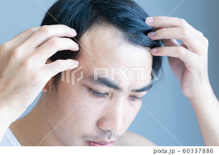 Young man serious hair loss problem for health 60337886