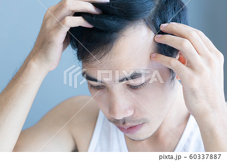 Young man serious hair loss problem for health 60337887
