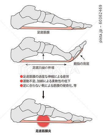 足底筋膜炎 足の骨 足の筋肉のイラスト素材