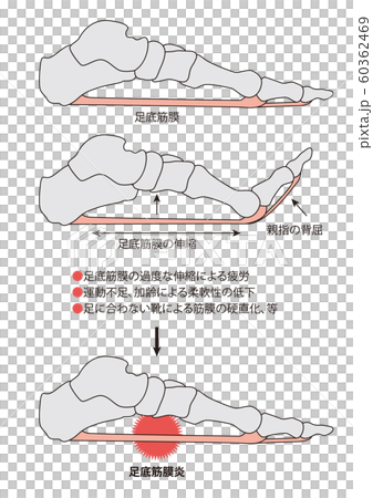 足底筋膜炎　足の骨　足の筋肉 60362469