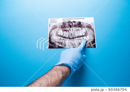 A dentist holding snapshot the patient's tooth and indicates the problem. Panoramic shot of the jaw on a blue isolated background. A dentist holding snapshot the patient's tooth and indicates the problem. Panoramic shot of the jaw on a blue isolated background. 60366704