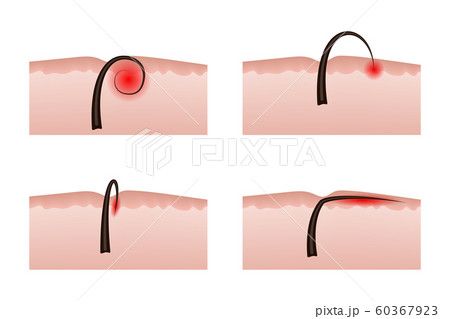 Ingrown hairs after depilation. 60367923