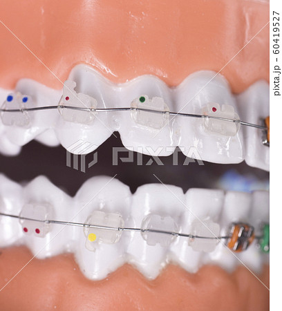 Dental brackets teeth straighteners Dental brackets teeth straighteners 60419527
