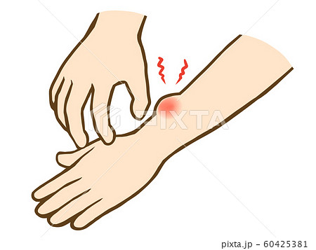 腕の虫刺され 60425381