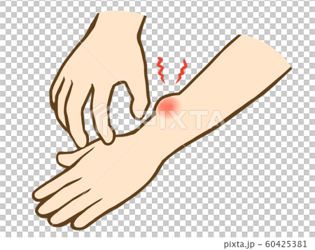 手臂被咬 60425381