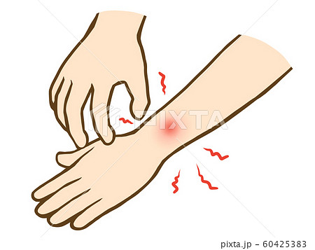 腕の虫刺され 60425383