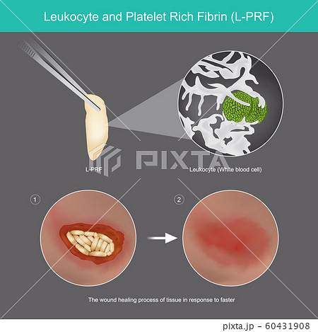 Leukocyte and Platelet Rich Fibrin. Illustration Leukocyte and Platelet Rich Fibrin. Illustration 60431908