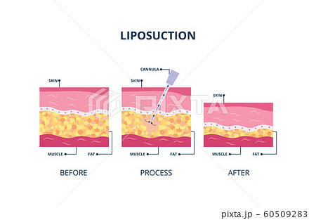 Suction-assisted liposuction procedure - skin layers vector illustration isolated. 60509283