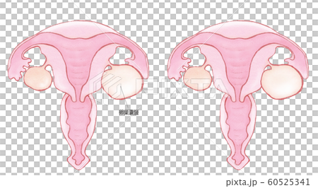 卵巣嚢腫 60525341