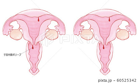 子宮 内 膜 ポリープ