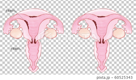Cervical cancer Endometrial cancer - Stock Illustration [60525343] - PIXTA