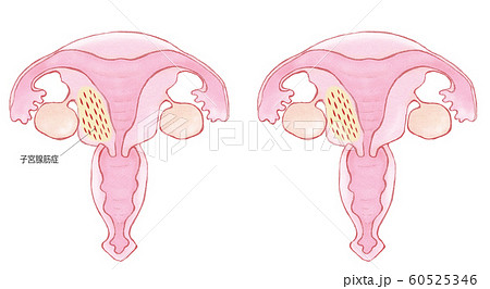 子宮腺筋症のイラスト素材