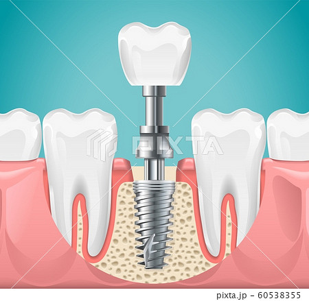 Dental surgery. Tooth implant cut vector illustration. Healthy teeth and dental implant, stomatology poster 60538355