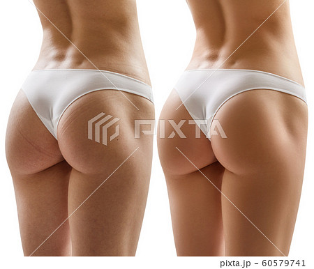 Female buttocks before and after treatment. 60579741