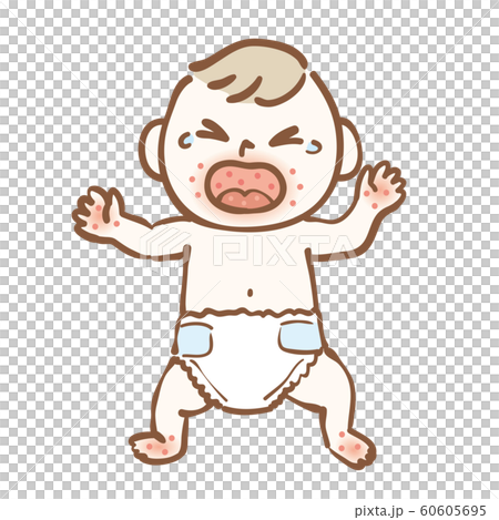 手足口病 赤ちゃん 手足口病 赤ちゃん 60605695