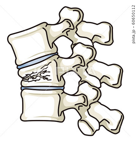 骨折がある脊椎 圧迫骨折のイラスト素材