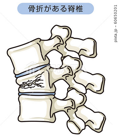 骨折がある脊椎 圧迫骨折のイラスト素材