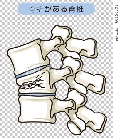 骨折がある脊椎 圧迫骨折のイラスト素材