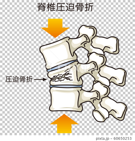 骨折がある脊椎 圧迫骨折のイラスト素材