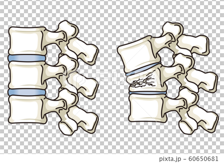 圧迫骨折 説明図のイラスト素材