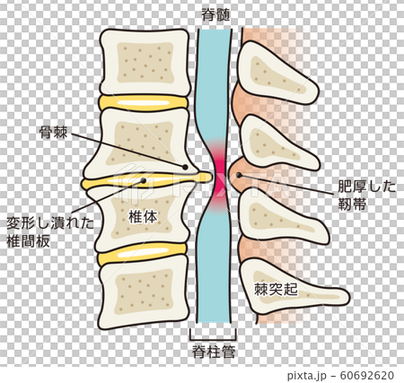 椎間板ヘルニア　医療 60692620