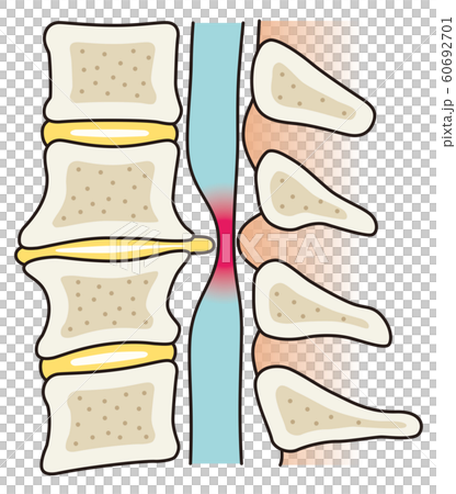 Intervertebral hernia medical 60692701