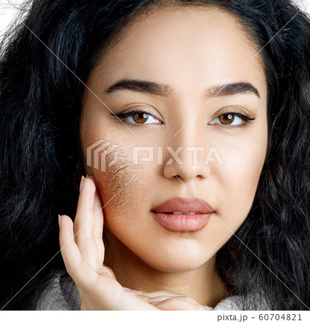 Young woman with dehydrated skin. Young woman with dehydrated skin. 60704821