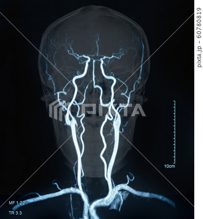 mri blood vessels 60780819