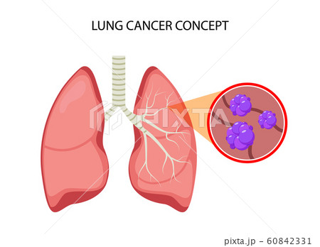 Lung cancer vector concept repiratory disease. Cartoon human lung cancer icon 60842331