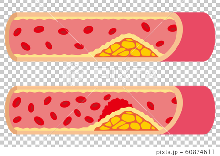 Atherosclerosis blood vessels Atherosclerosis blood vessels 60874611