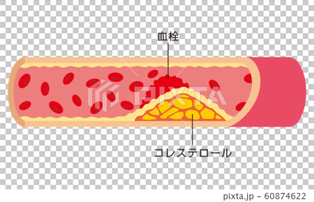 動脈硬化　血管 60874622