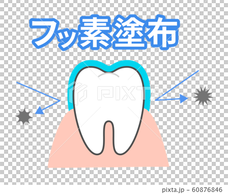 Effect of fluorine treatment Toothed character Dental illustration 60876846
