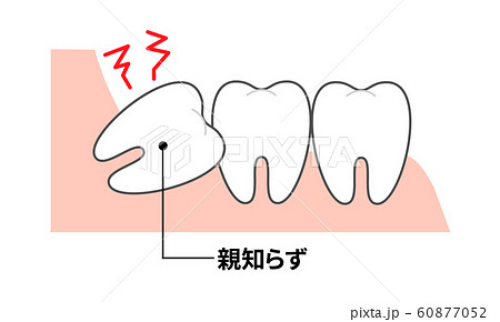 歯並び 親知らず図説 断面図 歯並び 親知らず図説 断面図 60877052