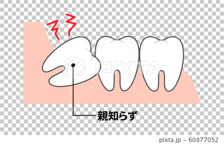 歯並び 親知らず図説 断面図 歯並び 親知らず図説 断面図 60877052