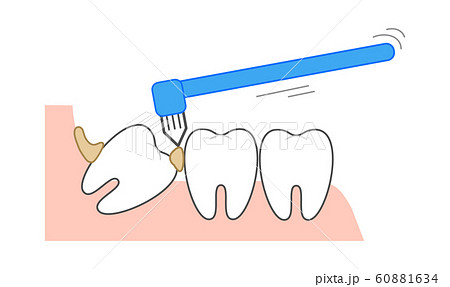 プラーク（歯垢）除去タフトブラシ歯並び　親知らず図説　断面図 60881634