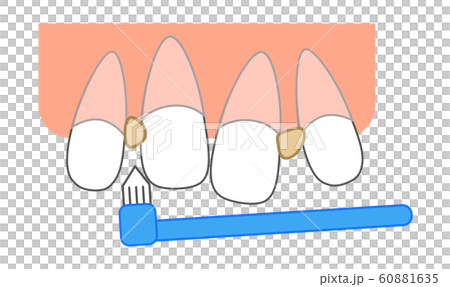 プラーク 歯垢 除去 前歯矯正隙間前歯のイラスト素材