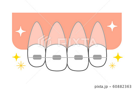 矯正器具前歯キラキラ図解のイラスト素材 6063
