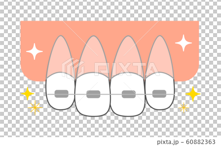 正畸矯治器前牙的圖示 60882363